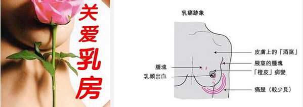 乳癌.jpg