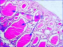 静止性淋巴细胞性甲状腺炎的图片