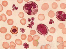 巨球蛋白血症的图片