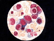 巨幼细胞性贫血的图片