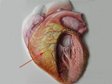 病毒性心肌炎的图片