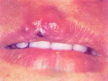 口腔单纯性疱疹的图片