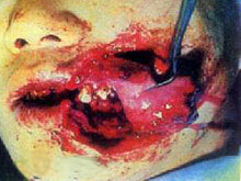 口腔颌面部软组织损伤的图片