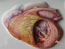 扩张型心肌病的图片