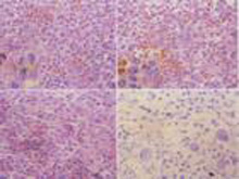 朗格汉斯细胞组织细胞增生症的图片