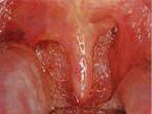 链球菌性咽炎的图片