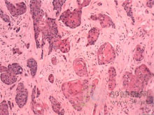 鳞状细胞癌的图片