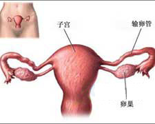 卵巢癌的图片