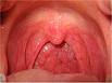 慢性单纯性咽炎的图片