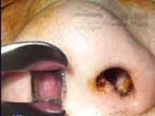 慢性肥厚性鼻炎的图片
