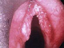 慢性喉炎的图片