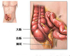 慢性阑尾炎的图片