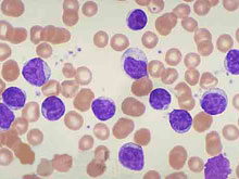慢性淋巴细胞性白血病的图片