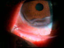 蚕蚀性角膜溃疡的图片