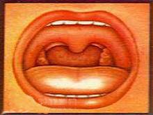 慢性舌扁桃体炎的图片
