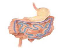 毛石肠梗阻综合征的图片
