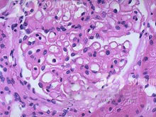 膜性肾小球肾炎的图片