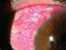 泡性角结膜炎的图片