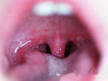 疱疹性咽峡炎的图片