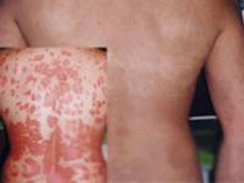 葡萄球菌性烫伤样皮肤综合征的图片