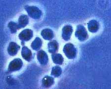 球孢子菌病的图片