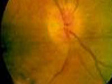 缺血性视盘病变的图片
