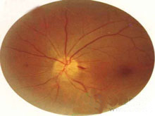 缺血性视神经病变的图片