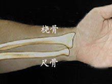 桡骨、尺骨茎突骨折的图片