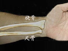 桡骨干下1/3骨折合并下尺桡关节脱位的图片