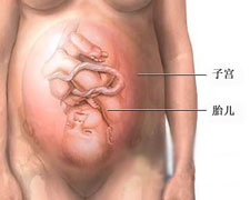妊娠合并皮质醇增多症的图片
