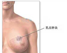 乳房纤维腺瘤的图片