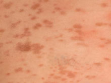 色素性荨麻疹的图片