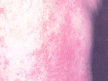 色素紫癜性皮炎的图片