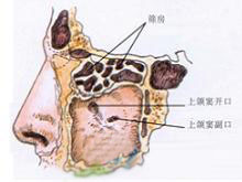 筛窦恶性肿瘤的图片