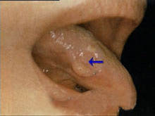 舌癌的图片
