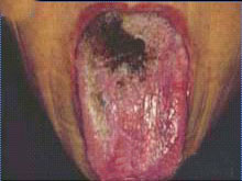 舌病的图片
