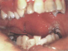 舌下间隙感染的图片