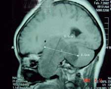 神经鞘瘤的图片