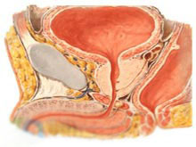 神经源性膀胱的图片