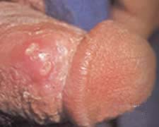 生殖器疱疹的图片