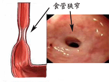 食管瘢痕性狭窄的图片