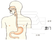 食管贲门粘膜撕裂综合征的图片