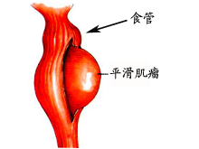 食管平滑肌瘤的图片
