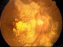 视网膜病变的图片