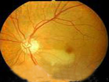 视网膜动脉阻塞的图片