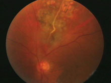 视网膜静脉周围炎的图片