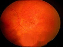 视网膜色素上皮炎的图片