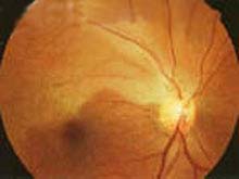 视网膜中央动脉阻塞的图片