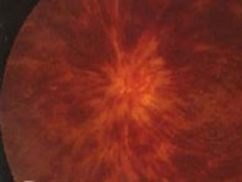 视网膜中央静脉阻塞的图片