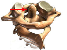 枢椎齿状突骨折的图片